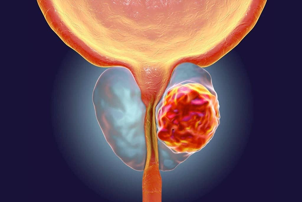 Cáncer de próstata: cifras que están aumentando y lo que puedes hacer para prevenirlo a tiempo